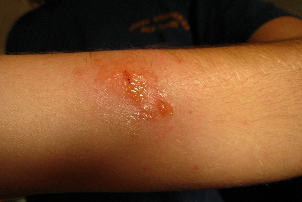 Dermatite allergique de contact au poison-ivy, Red River Gorge, USA