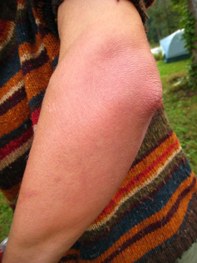 cellulite