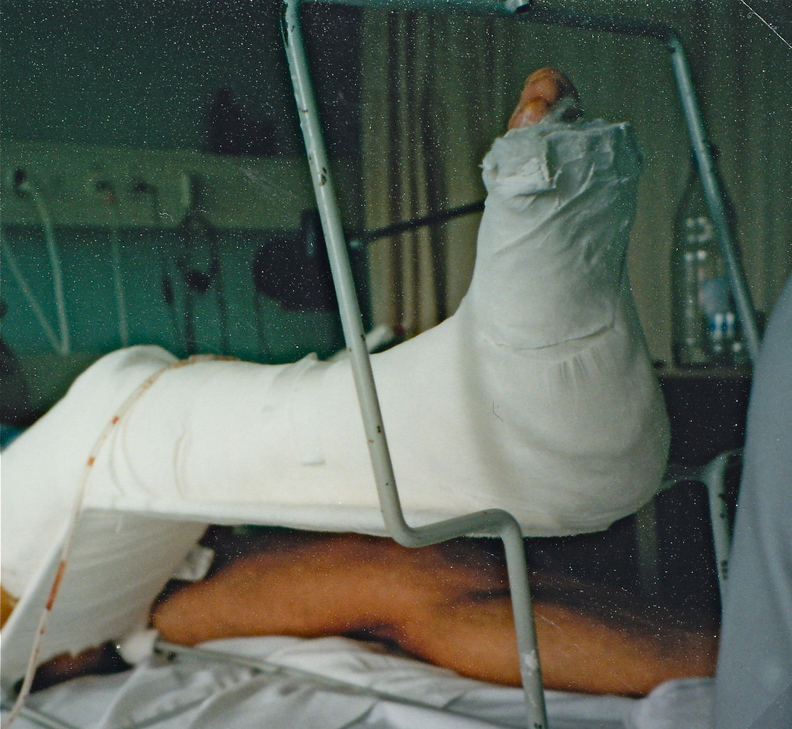 13 fractures, 13, ça porte bonheur